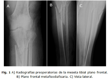 Radiografía preoperatoria de la meseta tibial, ortopedia Nutricare