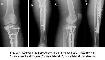 Radiografías posoperatoria de la meseta tibial. Ortopedia Nutricare