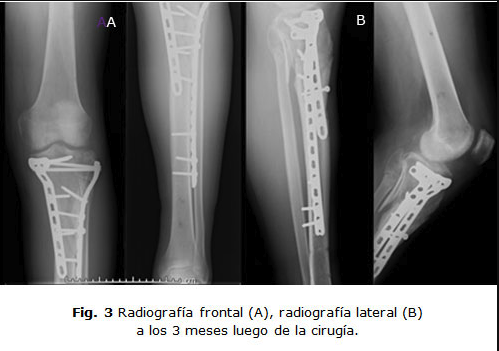 Radiografía frontal y lateral a los 3 meses luego de la cirugía. Ortopedia Nutricare