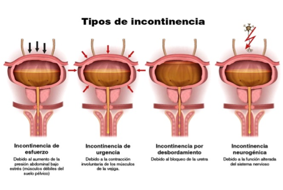 tipos de incontinencia 