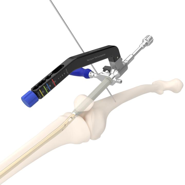 Clavo Neosupra para tibia